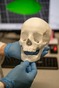PROFiBONE - implants can serve patients who lose part of their skull bone after surgery